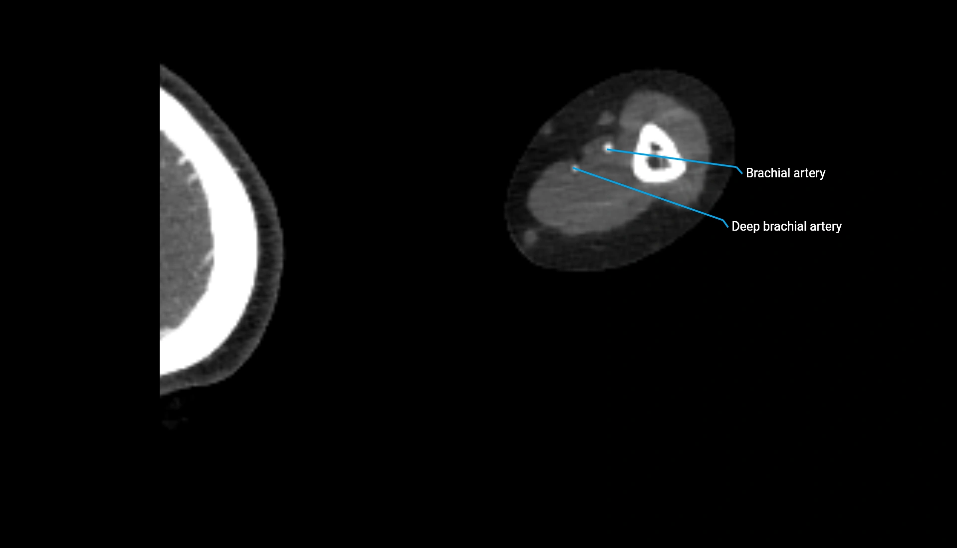 CTA upper limb axial cross sectional anatomy labelled image 215 (2).webp